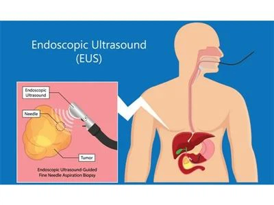 Hvad er endoskopisk ultralyd (EUS)?