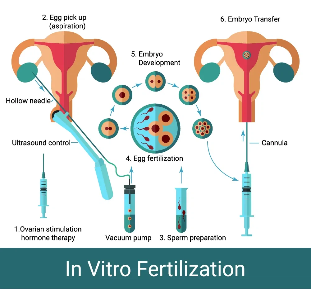 Effektiviteten af ​​forskellige størrelser af æghentning nåle i IVF -procedurer