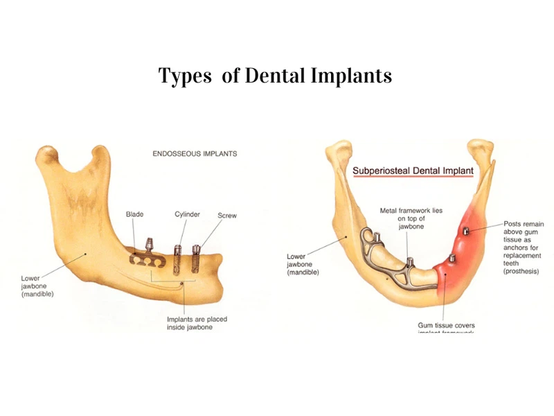 Classification Of Implants Classification Of Implants