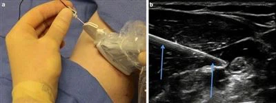Ultralydets rolle i forbedring af nervebloknålens præcision
